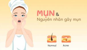 Nguyên nhân và cách ngăn ngừa mụn đơn giản, hiệu quả